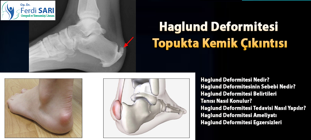 Haglund Deformitesi (topukta kemik çıkıntısı) nedir? Belirtileri, nedenleri, egzersiz ve cerrahi tedavi yöntemlerini Ortopedi Uzmanı Dr. Ferdi SARI anlatıyor.