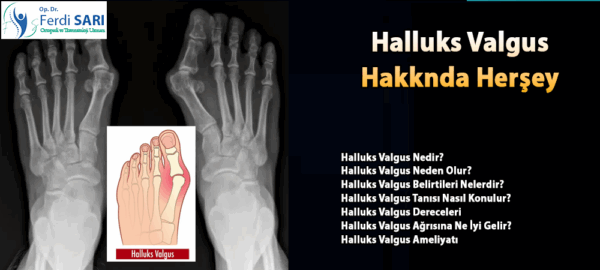 Halluks Valgus Ameliyatı nedir Dr. ferdi sarı