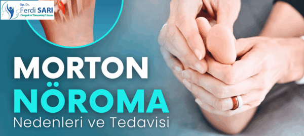 Morton nöroma belirtileri ve ağrı bölgeleri şematik gösterim.
