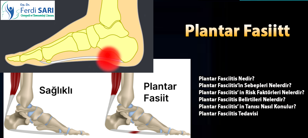 Plantar fasiitte egzersiz, ESWT ve PRP tedavileri. Sabah topuk ağrısı nasıl geçer? Dr. Ferdi SARI'nın güncel rehberi. Ameliyatsız çözümler!