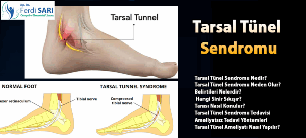Tarsal tünel sendromu belirtileri, tanı, tedavi ve ameliyat süreci hakkında detaylı bilgi. Op. Dr. Ferdi SARI anlatıyor.