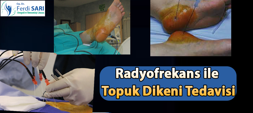 Radyofrekans ile Topuk Dikeni Belirtileri ve Radyofrekans Tedavisi | Dr. Ferdi SARI'nın Güncel Rehb Topuk Dikeni Tedavisi Topukta ağrı ve batma hissinin belirtileri"