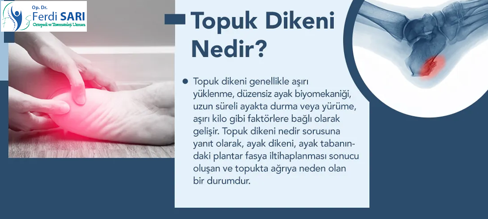 Topuk Dikeni Tedavi Yöntemleri: Radyofrekans ve Modern Yaklaşımlar Topuk dikeni tedavi yöntemleri nelerdir? Radyofrekans yöntemiyle etkili çözümleri Dr. Ferdi SARI anlatıyor.