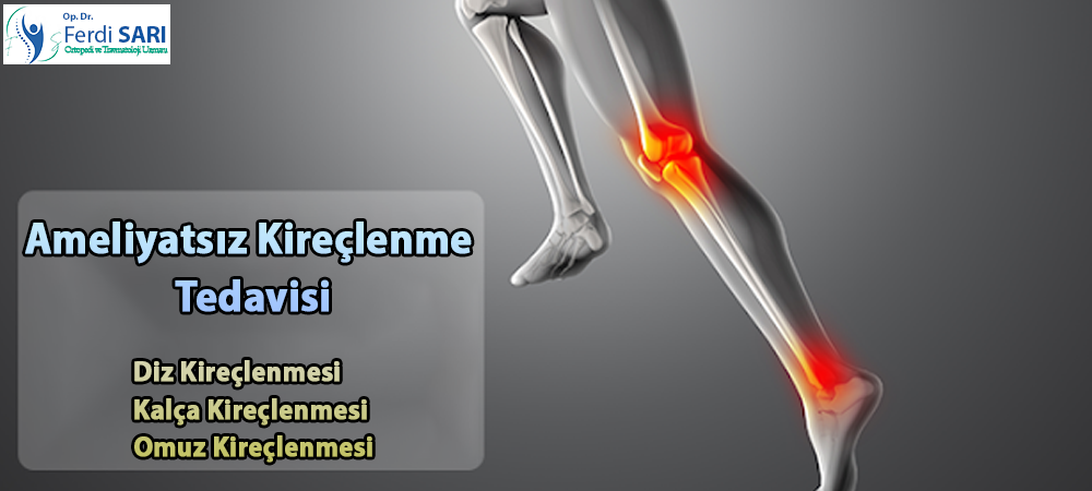 Ameliyatsız Kireçlenme Tedavisi Kireçlenme Tedavi Yöntemleri: Belirtiler ve Modern Yaklaşımlar